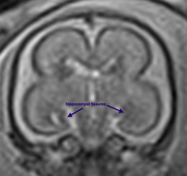 File:Normal brain fetal MRI - 22 weeks (Radiopaedia 50623-56604 Sulcation 4).jpg
