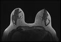 Normal breast MRI - dense breasts (Radiopaedia 80454-93850 Axial T1 98).jpg
