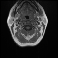 Normal cervical and thoracic spine MRI (Radiopaedia 35630-37156 Axial T1 26).png