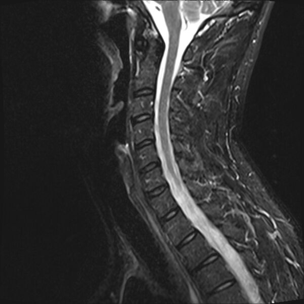 File:Normal cervical spine MRI (Radiopaedia 38418-40496 Sagittal STIR 6).jpg