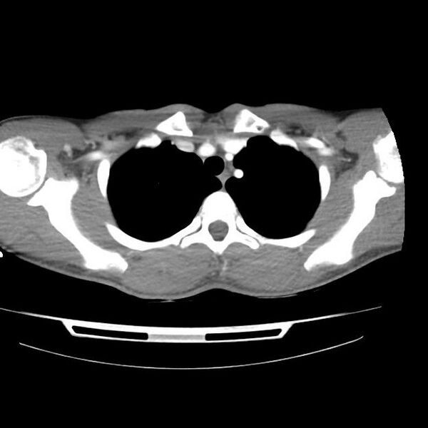 File:Normal dual-phase trauma CT chest,abdomen and pelvis (Radiopaedia 48092-52899 A 10).jpg