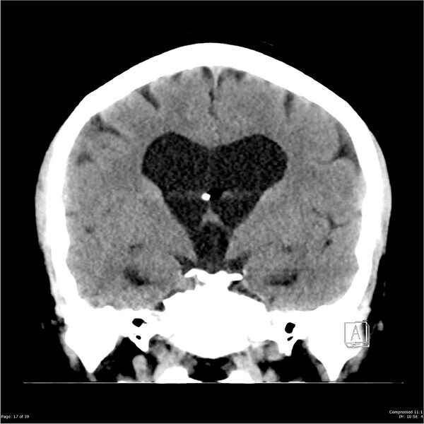 File:Normal pressure hydrocephalus (Radiopaedia 24415-24736 Coronal non-contrast 13).jpg