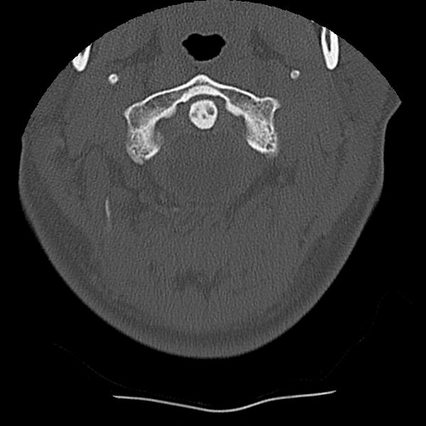 File:Normal trauma spine imaging (Radiopaedia 31753-32686 Axial bone window 8).jpg