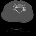 Normal trauma spine imaging (age 16) (Radiopaedia 45335-49358 Axial bone window 54).jpg