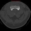 Occipital condyle fracture (Radiopaedia 18366-18208 Axial bone window 24).jpg