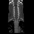 Occipital condyle fracture (Radiopaedia 31755-32691 Coronal bone window 16).jpg