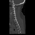 Occipital condyle fracture (Radiopaedia 31755-32691 Sagittal bone window 29).jpg