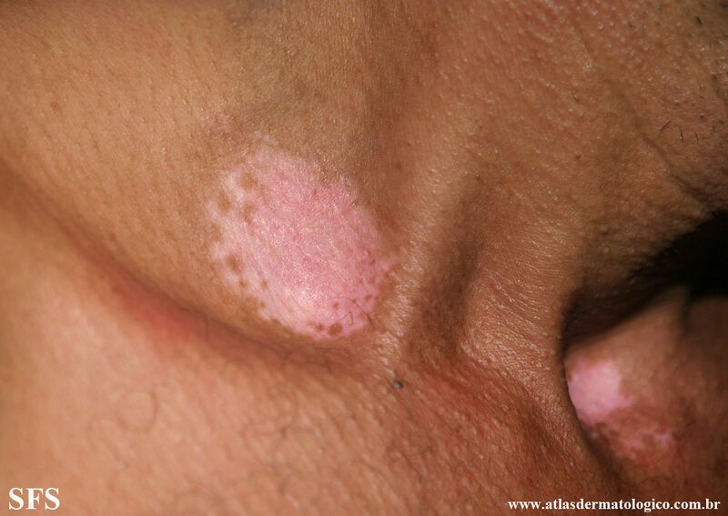 File:Vitiligo (Dermatology Atlas 63).jpg