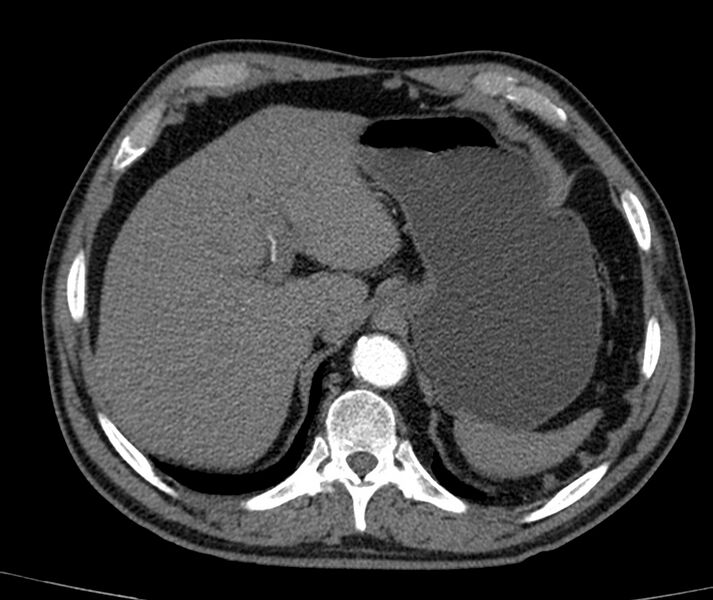 File:Abdominal aortic aneurysm (Radiopaedia 22421-22458 C+ arterial phase 1).jpg
