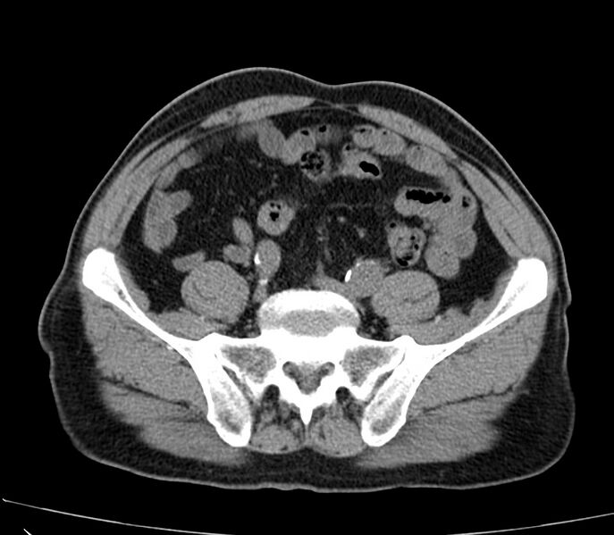 File:Abdominal aortic aneurysm (Radiopaedia 22421-22458 non-contrast 40).jpg