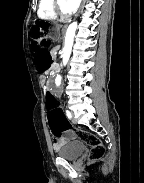 File:Abdominal aortic aneurysm (Radiopaedia 83581-98689 Sagittal C+ arterial phase 56).jpg