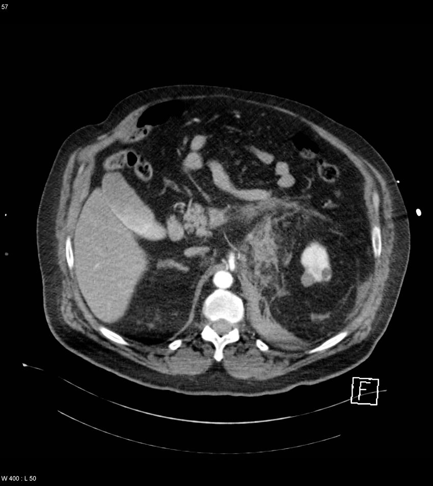 Abdominal aortic aneurysm with intramural hematoma then rupture (Radiopaedia 50278-55632 Axial C+ arterial phase 56).jpg