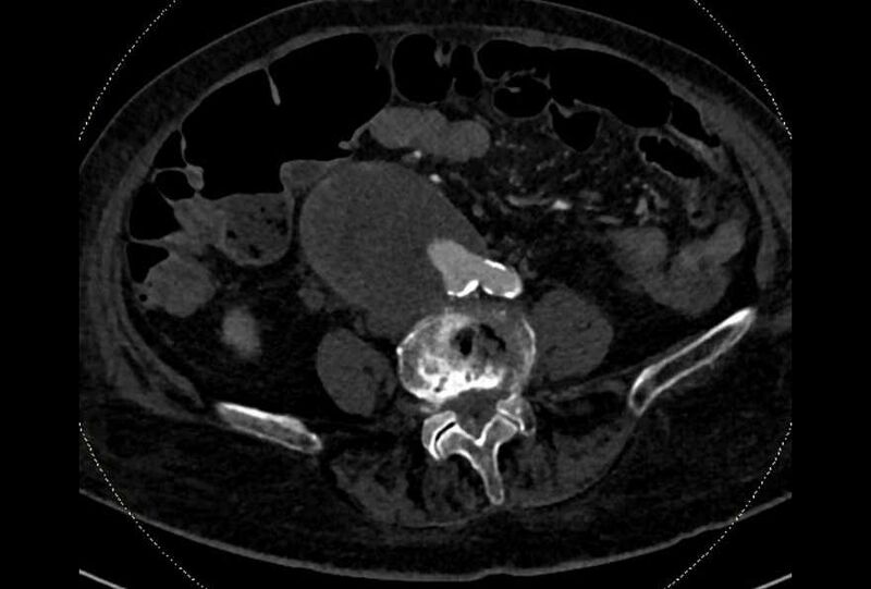 File:Abdominal aortic aneurysm with thrombus fissuration (Radiopaedia 73192-83919 Axial C+ arterial phase 134).jpg