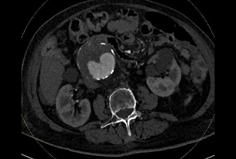 File:Abdominal aortic aneurysm with thrombus fissuration (Radiopaedia 73192-83919 Axial C+ arterial phase 86).jpg