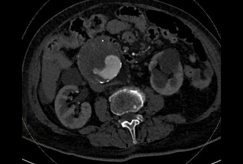 File:Abdominal aortic aneurysm with thrombus fissuration (Radiopaedia 73192-83919 Axial C+ arterial phase 96).jpg
