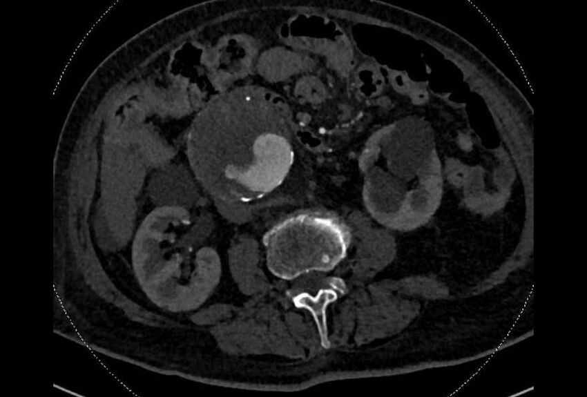 Abdominal aortic aneurysm with thrombus fissuration (Radiopaedia 73192-83919 Axial C+ arterial phase 96).jpg