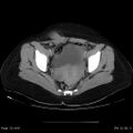Abdominal wall endometriosis (Radiopaedia 25723-25885 Axial C+ portal venous phase 32).jpg