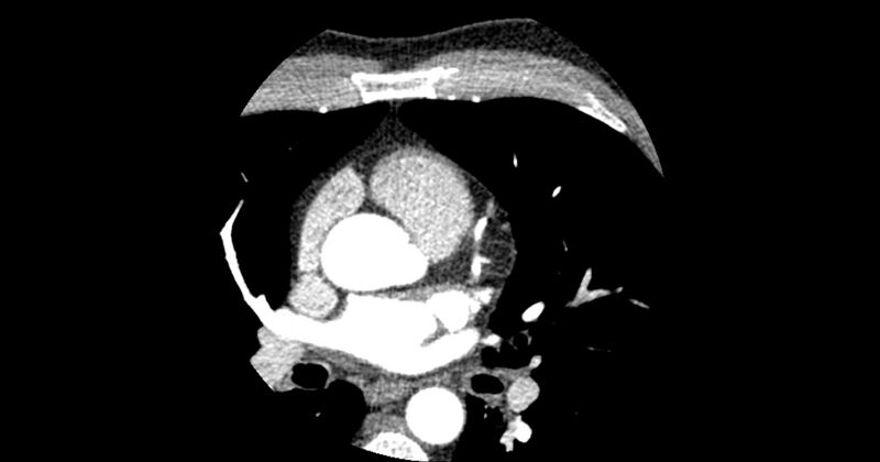 File:Aberrant left main coronary artery (ALMCA) arising from the right sinus with interarterial course (Radiopaedia 63251-71814 Axial C+ arterial phase 53).JPG