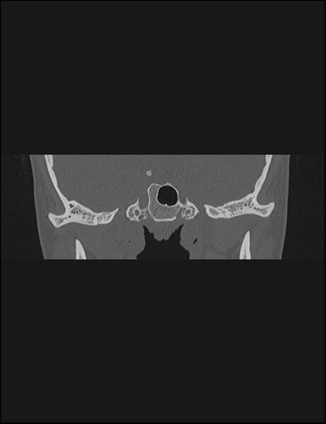 File:Aberrant right internal carotid artery (Radiopaedia 65191-74198 Coronal non-contrast 12).jpg