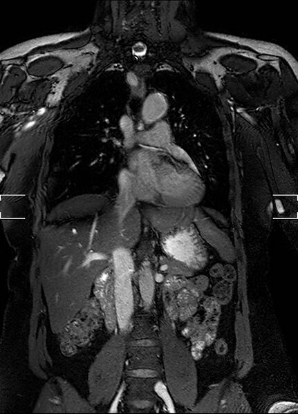 File:Aberrant right subclavian artery with background Takayasu arteritis (Radiopaedia 21423-21363 Coronal MRA 12).jpg
