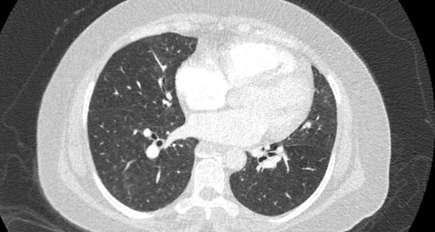 Accessory right inferior hepatic vein (Radiopaedia 65245-74259 Axial lung window 44).jpg