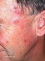 Actinic Keratoses treated with imiquimod (DermNet NZ lesions-ak-imiquimod-3749).jpg