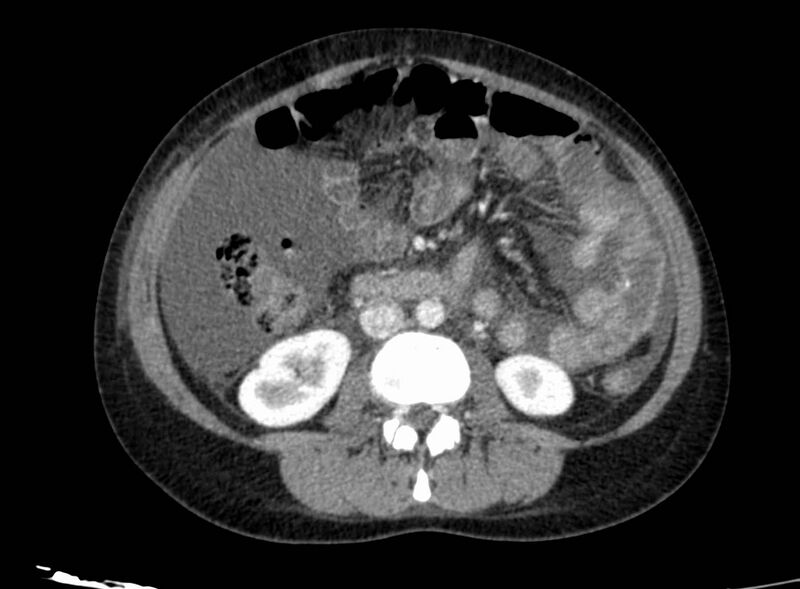 File:Acute Budd-Chiari syndrome (Radiopaedia 60858-68638 Axial C+ portal venous phase 154).jpg