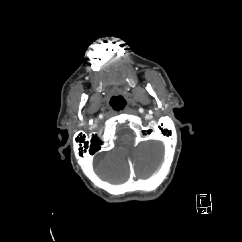 Acute ICA ischemic penumbra due to high-grade CCA stenosis (CT perfusion) (Radiopaedia 72038-82530 Axial C+ arterial phase 25).jpg