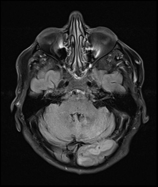 File:Acute P1 occlusion with PCA ischemia penumbra (CT perfusion) (Radiopaedia 72084-82590 Axial FLAIR 9).jpg