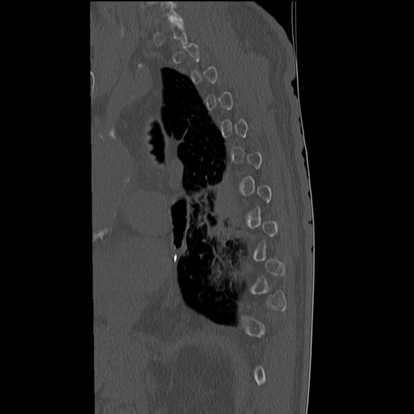 File:Acute and chronic vertebral compression fractures (Radiopaedia 31608-32494 Sagittal bone window 2).jpg