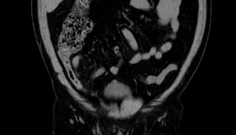 File:Acute appendicitis (Radiopaedia 13030-13091 Coronal non-contrast 2).jpg