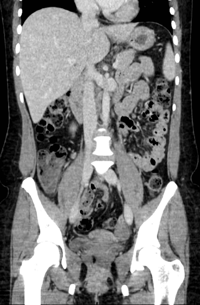 File:Acute appendicitis (Radiopaedia 22892-22918 Coronal C+ portal venous phase 26).png