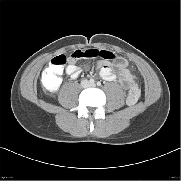 File:Acute appendicitis (Radiopaedia 25364-25615 B 39).jpg