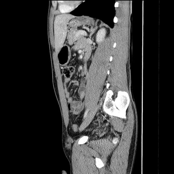 File:Acute appendicitis (Radiopaedia 27049-27227 Sagittal C+ portal venous phase 51).jpg
