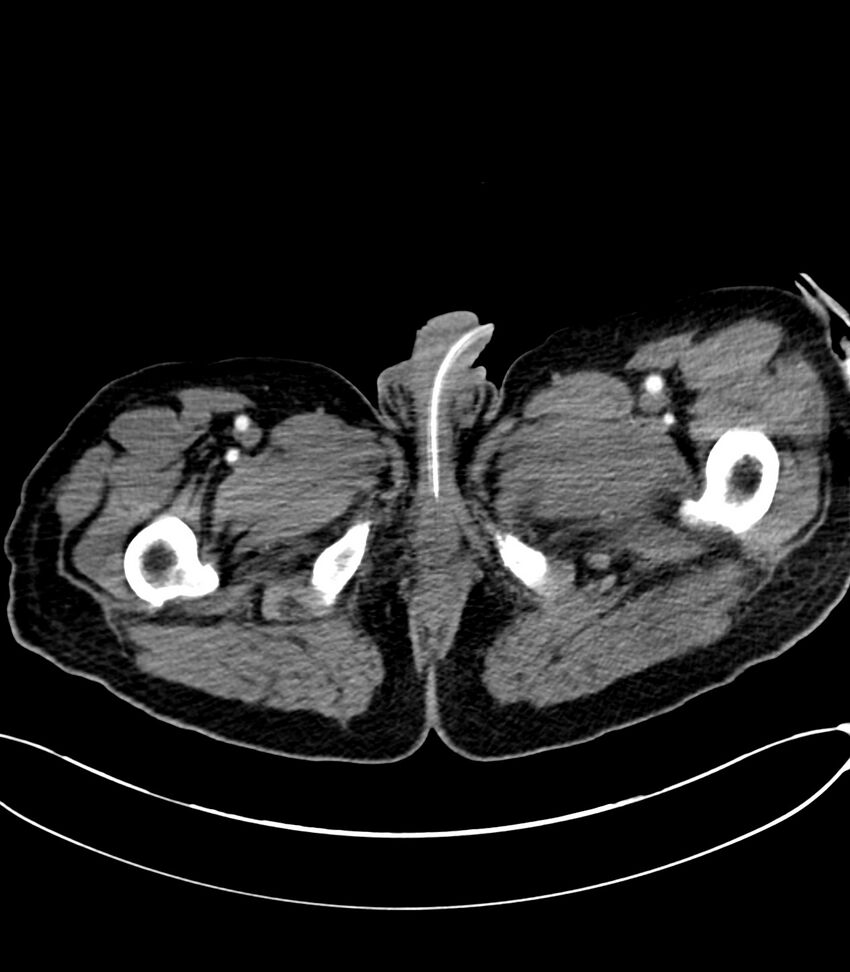 Acute arterial mesenteric ischemia (Radiopaedia 78238-90828 Axial C+ arterial phase 158).jpg
