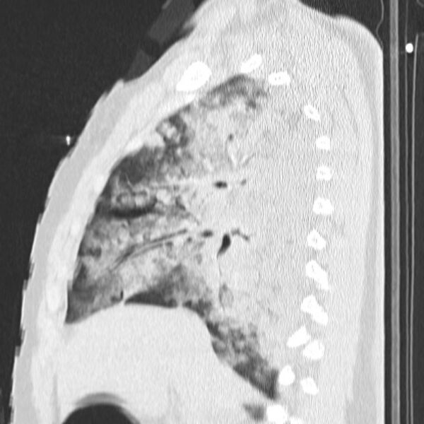 File:Acute aspiration pneumonitis (Radiopaedia 33605-34703 Sagittal lung window 35).jpg