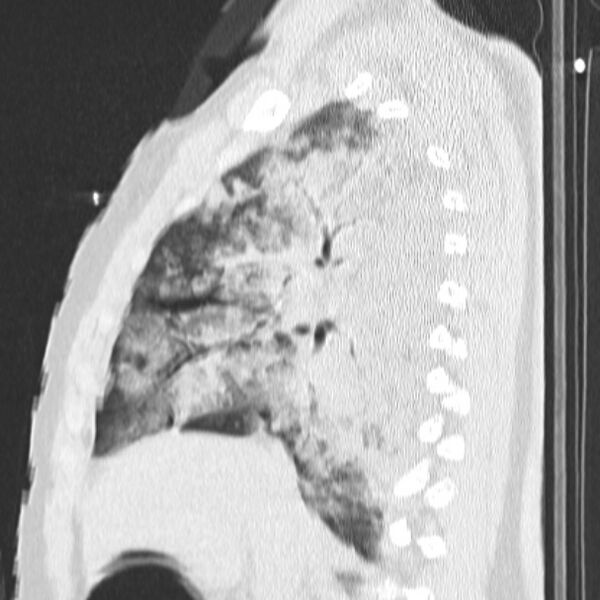 File:Acute aspiration pneumonitis (Radiopaedia 33605-34703 Sagittal lung window 36).jpg