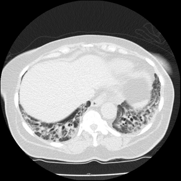 File:Acute interstitial pneumonitis (Radiopaedia 45404-49444 Axial lung window 81).jpg
