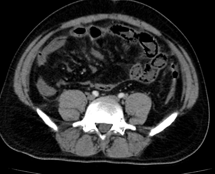 File:Acute mesenteric ischemia - superior mesenteric artery thrombosis (Radiopaedia 73947-84776 Axial C+ arterial phase 104).jpg