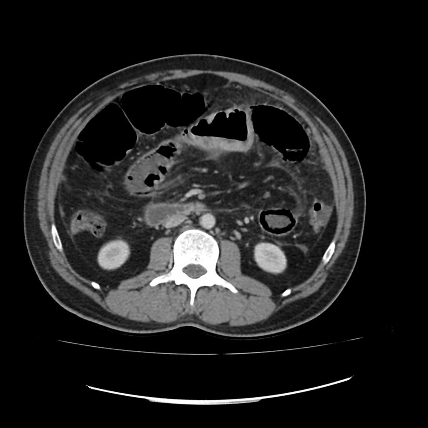 Acute mesenteric ischemia - superior mesenteric artery thrombosis (Radiopaedia 73947-84776 Axial C+ portal venous phase 62).jpg