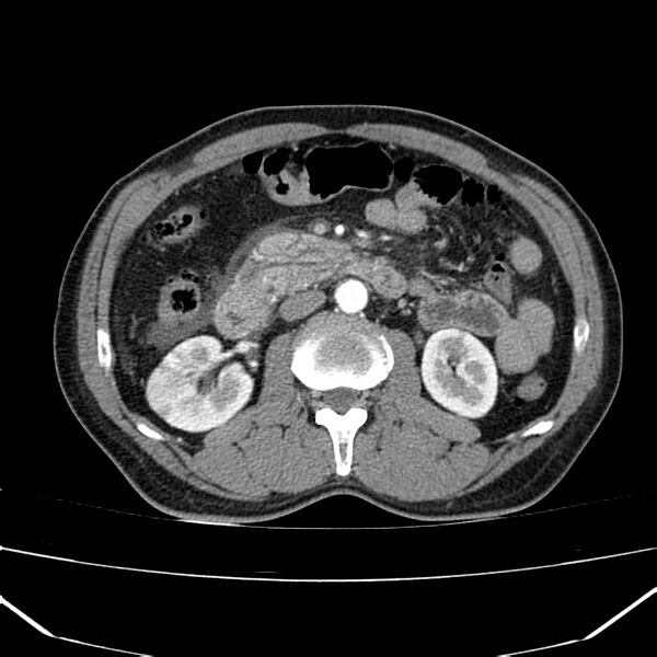 File:Acute pancreatitis (Radiopaedia 22572-22596 Axial C+ arterial phase 34).jpg