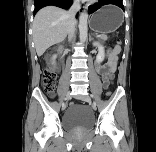 File:Acute pancreatitis (Radiopaedia 22572-22596 Coronal C+ portal venous phase 31).jpg