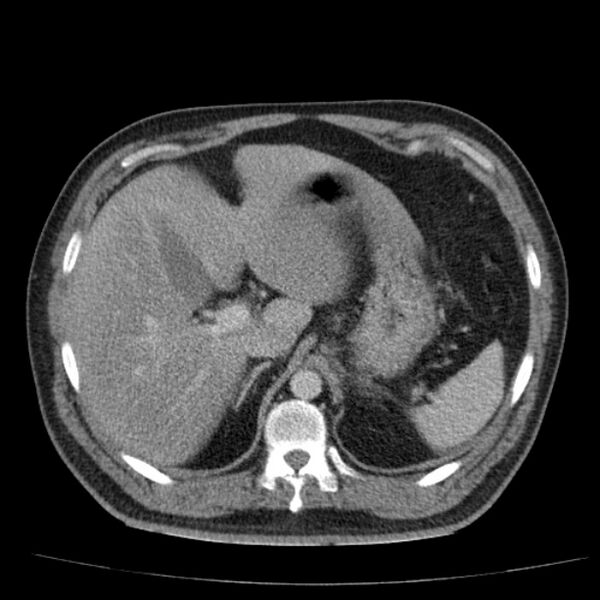 File:Acute pancreatitis (Radiopaedia 26663-26813 Axial C+ portal venous phase 20).jpg