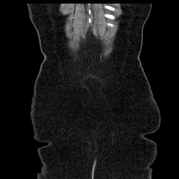 File:Acute pancreatitis - Balthazar C (Radiopaedia 26569-26714 Coronal C+ portal venous phase 67).jpg