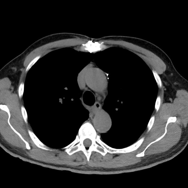 File:Acute pulmonary embolism (Radiopaedia 81677-95570 Axial non-contrast 6).jpg