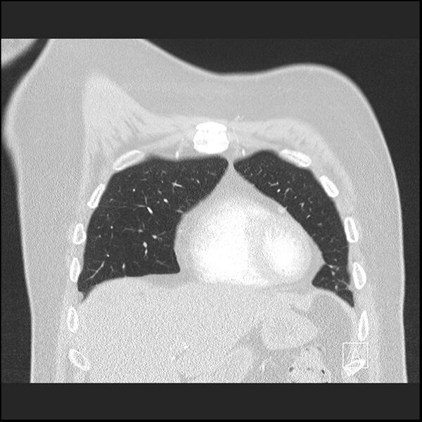 File:Acute pulmonary embolism with pulmonary infarct (Radiopaedia 73062-83768 Coronal lung window 16).jpg
