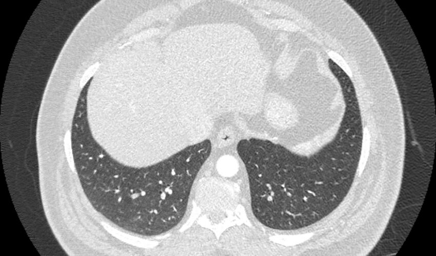 Acute pulmonary embolism with pulmonary infarcts (Radiopaedia 77688-89908 Axial lung window 106).jpg