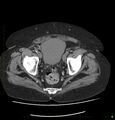 Acute renal failure post IV contrast injection- CT findings (Radiopaedia 47815-52557 Axial non-contrast 72).jpg