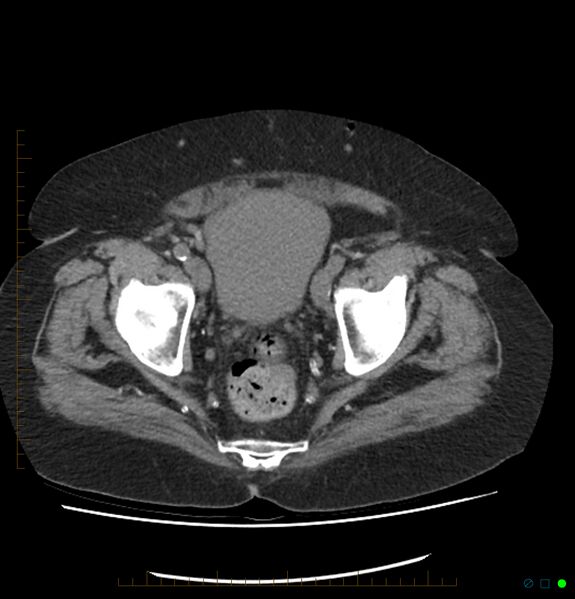 File:Acute renal failure post IV contrast injection- CT findings (Radiopaedia 47815-52557 Axial non-contrast 72).jpg