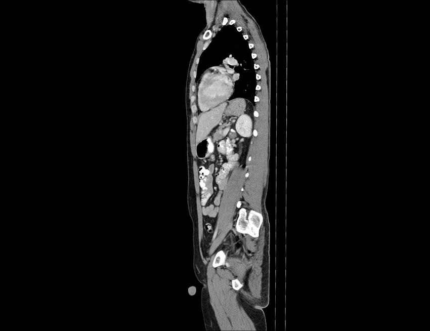 Addison disease (Radiopaedia 49318-54412 Sagittal C+ portal venous phase 25).jpg